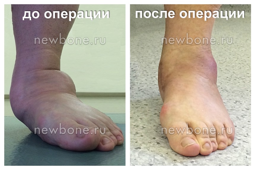 Плоскостопие фронт до после