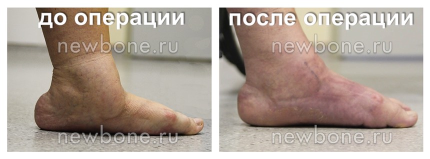 Плоскостопие мед до после